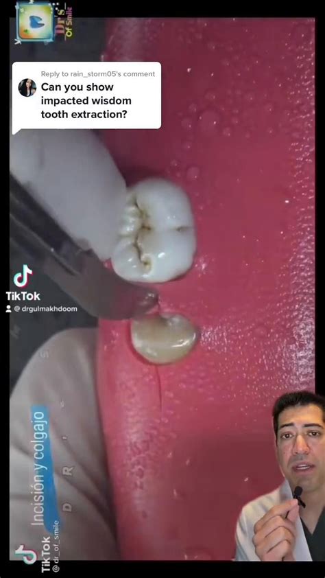 most wisdom teeth videos are fake